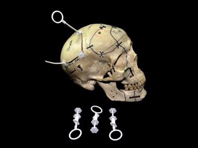 CranioStop Kranial Fiksasyon Sistemi